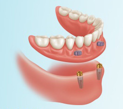 lower denture stabilization
