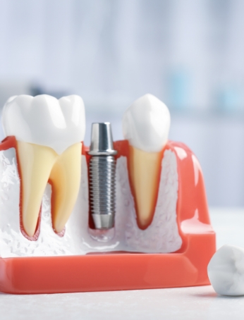 Dental Implants Solutions Image